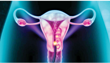 Why cervical cancer is killing more women in rural areas
