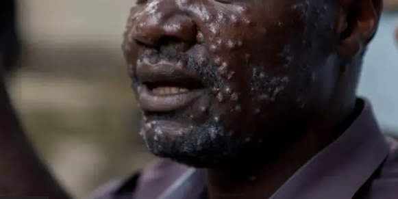 Mpox inasalia kuwa dharura ya kiafya ya umma kimataifa