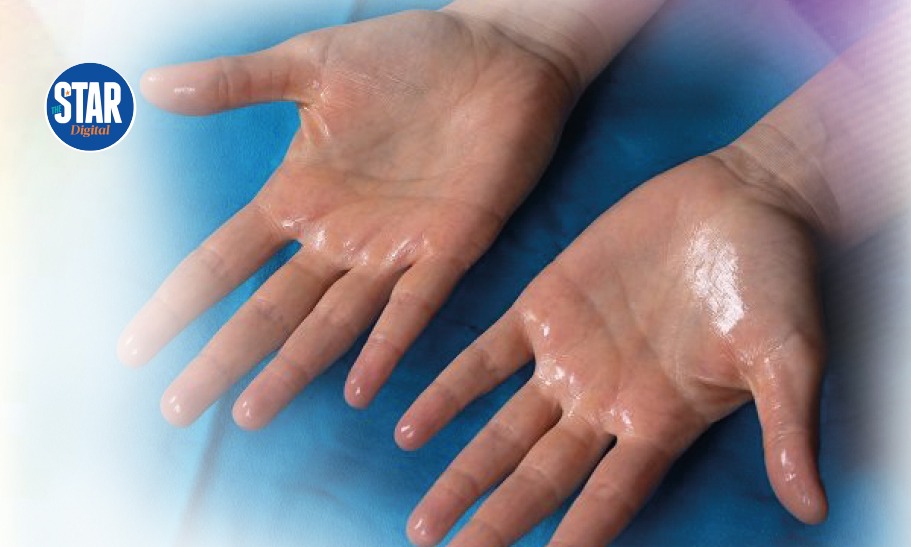 What you need to know about hyperhidrosis