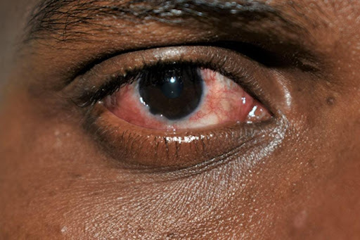 Scientists nail culprit behind Kenya's ‘Red Eye’ outbreak