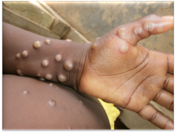 Why WHO has declined to lift Mpox emergency status