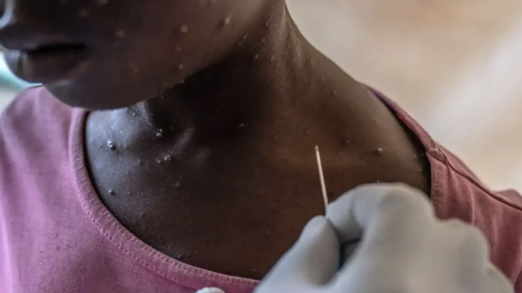 First two cases of Mpox recorded in Tanzania, health ministry