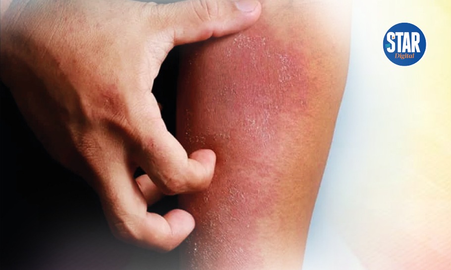 How to prevent fungal skin infections