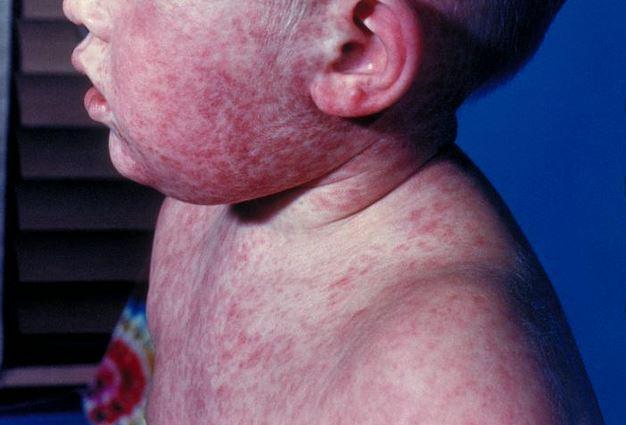 Second child dies of measles as Texas outbreak worsens