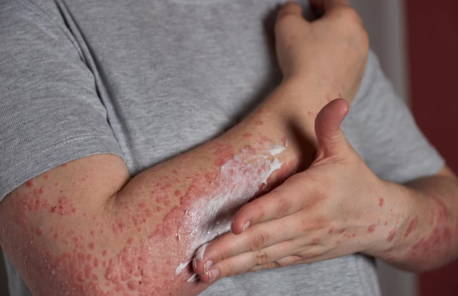 Measles holiday warning as cases rise in Europe