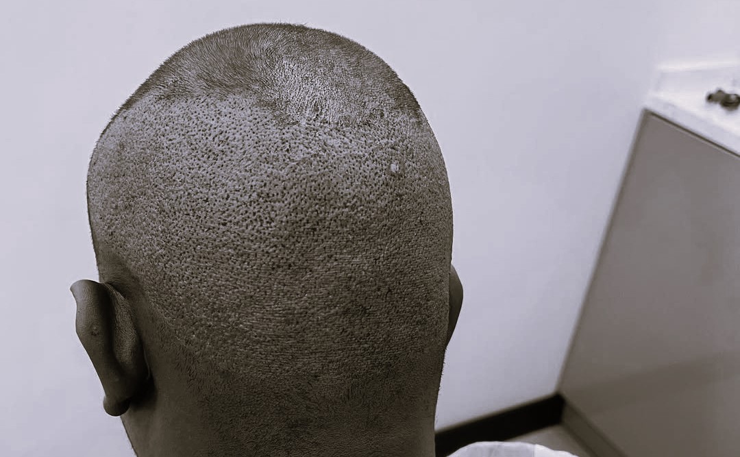A Look at Kenyan Celebrity Hair Transplants & How It Works