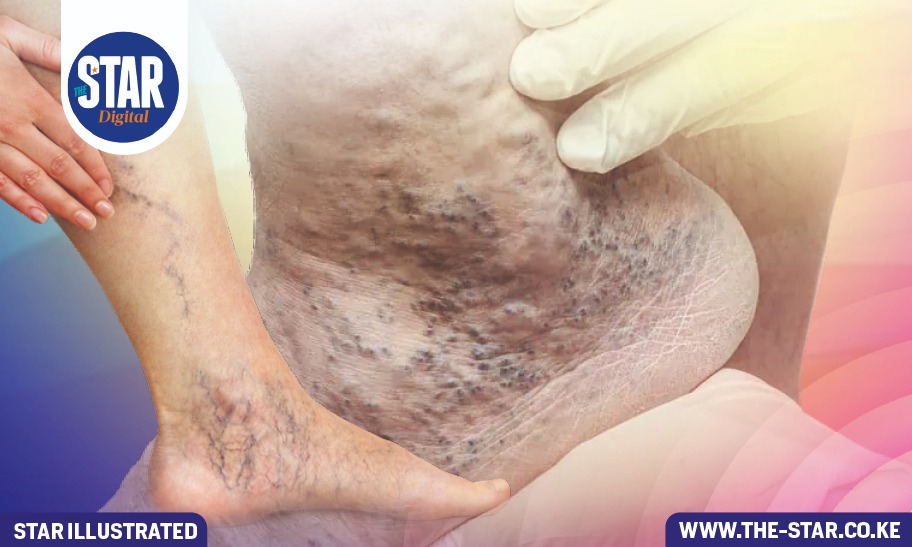 What to know about Varicose Veins