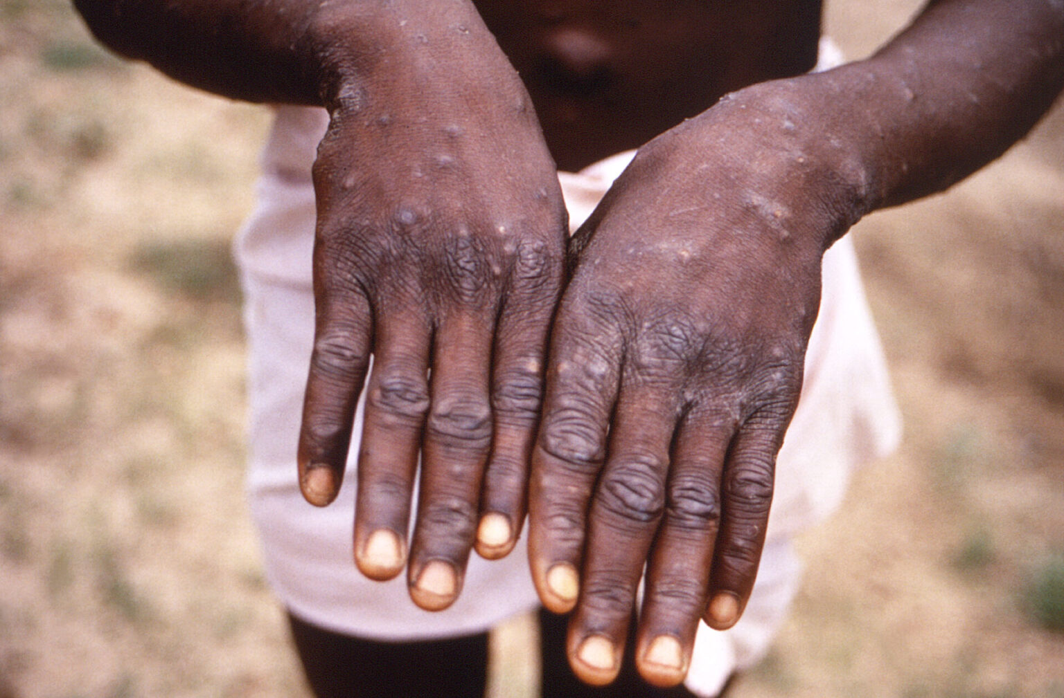 Funding cuts threaten Africa’s Mpox fight as 50,000 cases reported - WHO