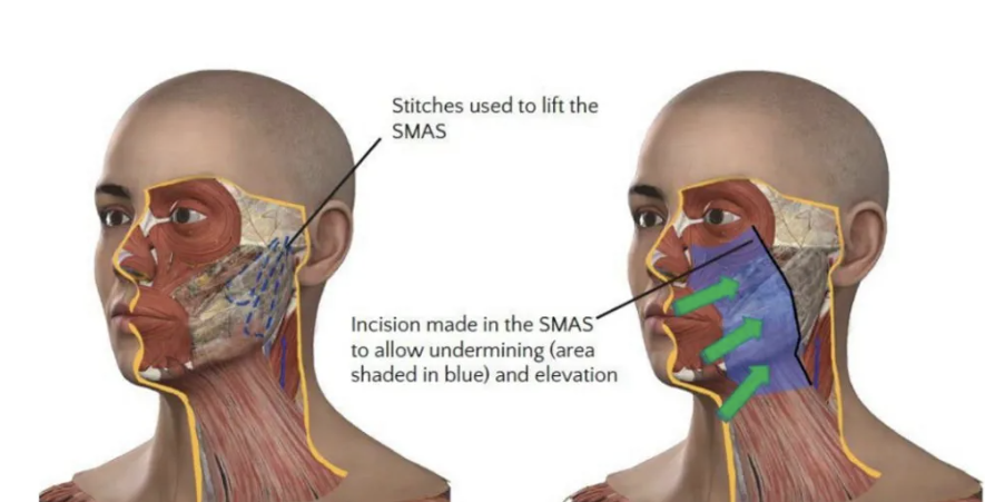 A facelift at 28? Why young people are turning to plastic surgery