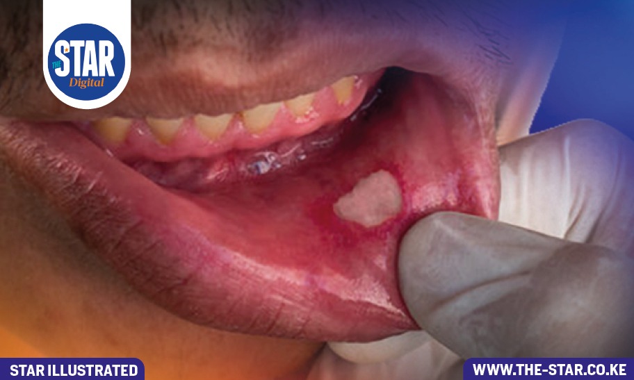 What causes mouth sores