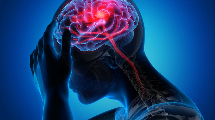 EXPLAINER: What to know about World Stroke Day