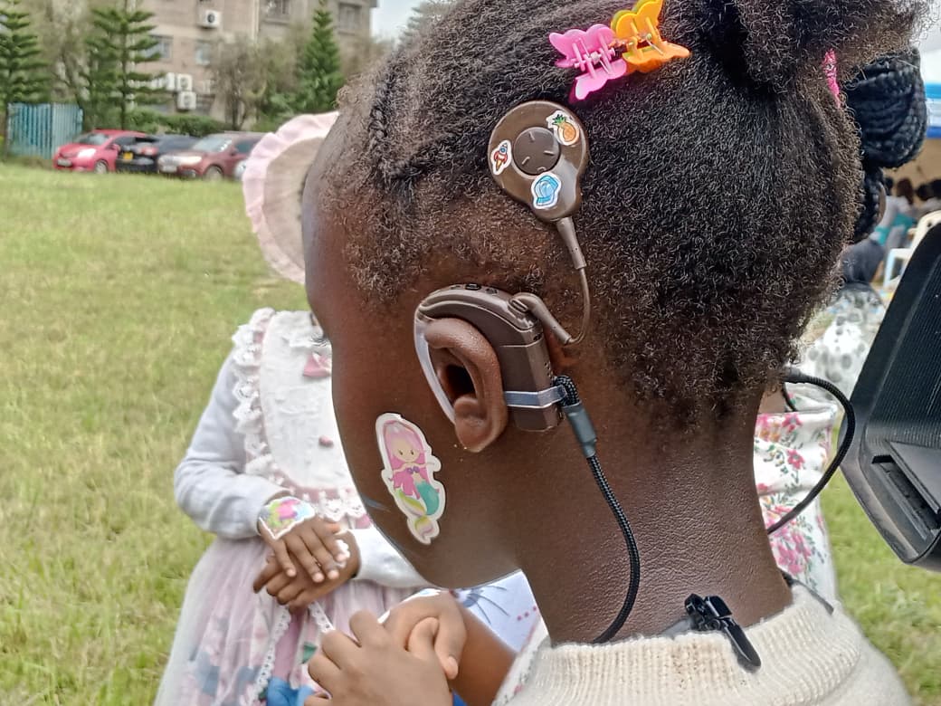 How cochlear implants have transformed lives