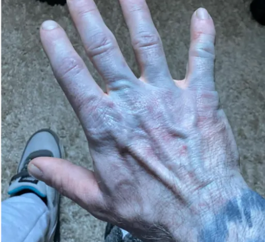 Man's blue skin A&E panic was just bed sheet dye