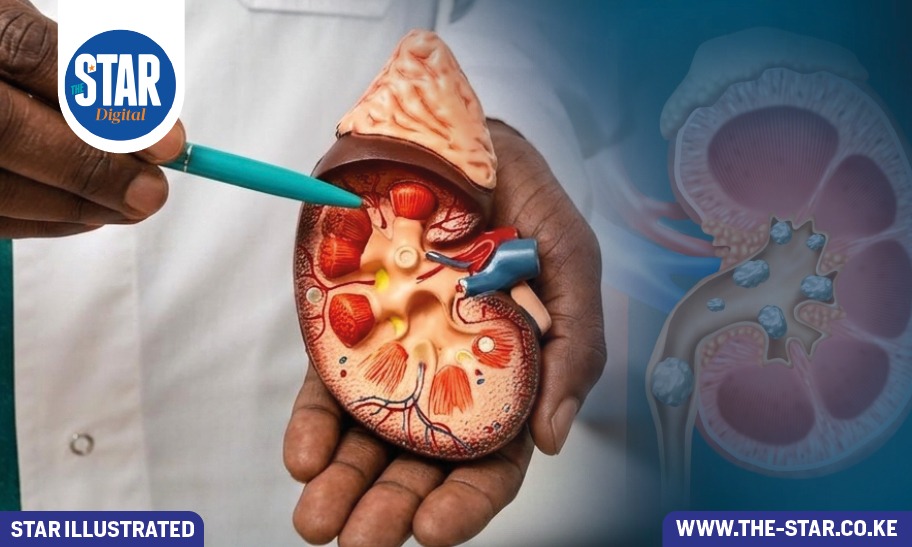 Signs and symptoms of kidney stones
