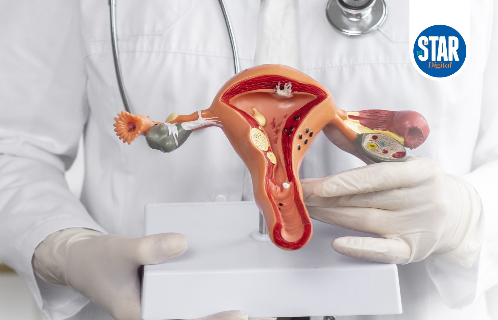 Signs and symptoms of Polycystic Ovary Syndrome