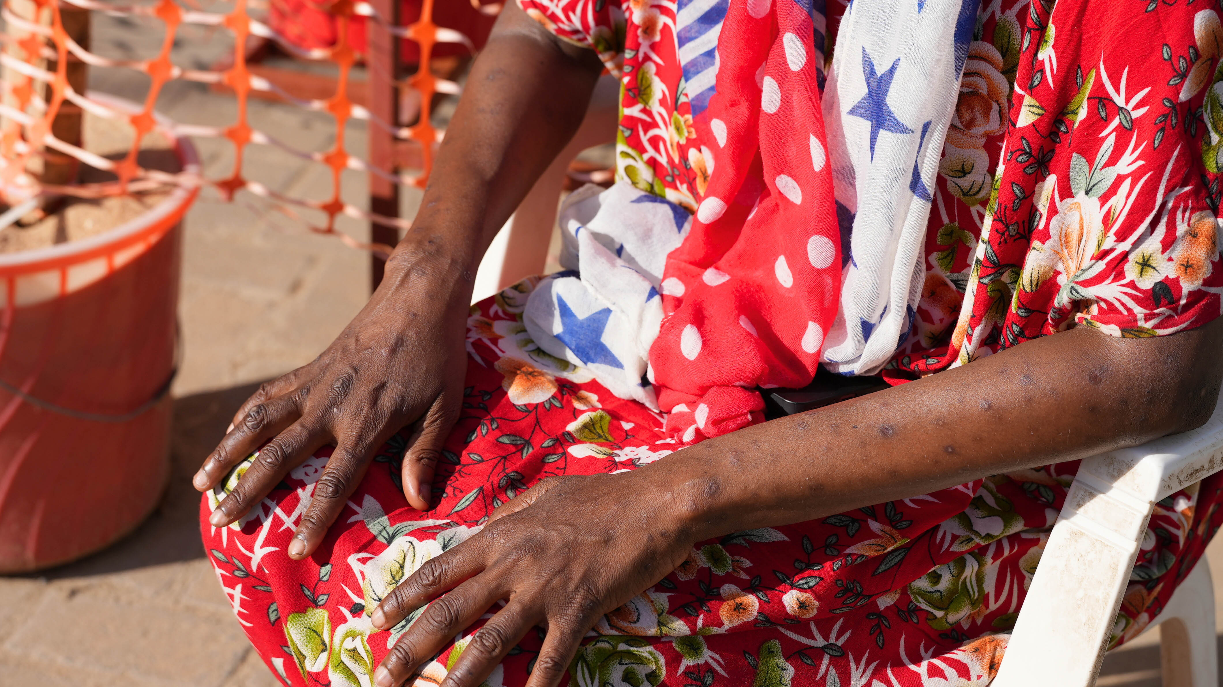 Mpox myths collapse as virus spreads to ordinary Kenyans