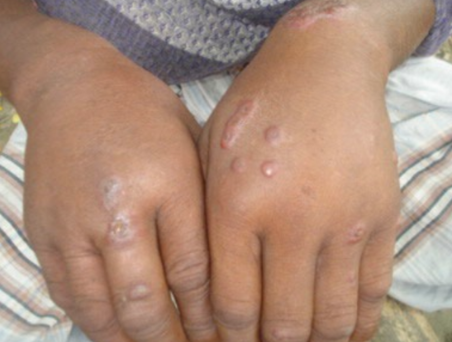 Siaya residents warned of Anthrax outbreak
