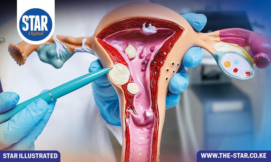 Uterine fibroids: Signs and symptoms
