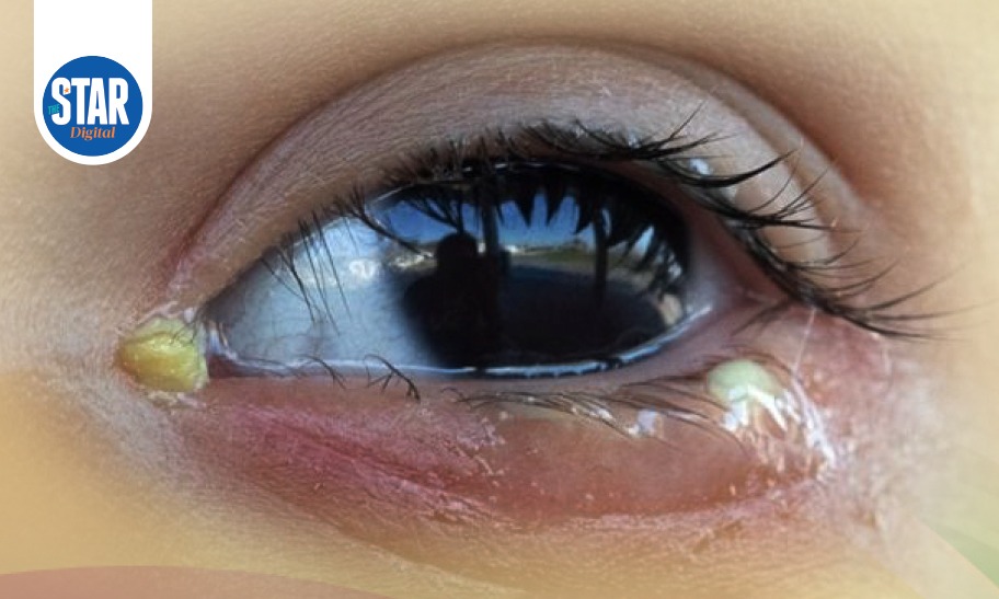 White eye discharge: What you need to know