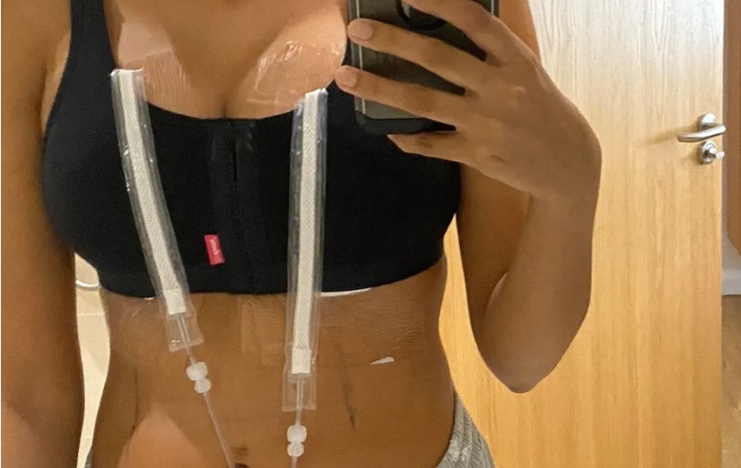 Why breast reductions are more popular now