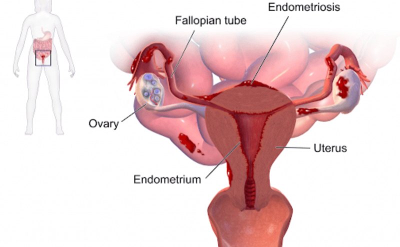 Endometriosis and the long road to recognition