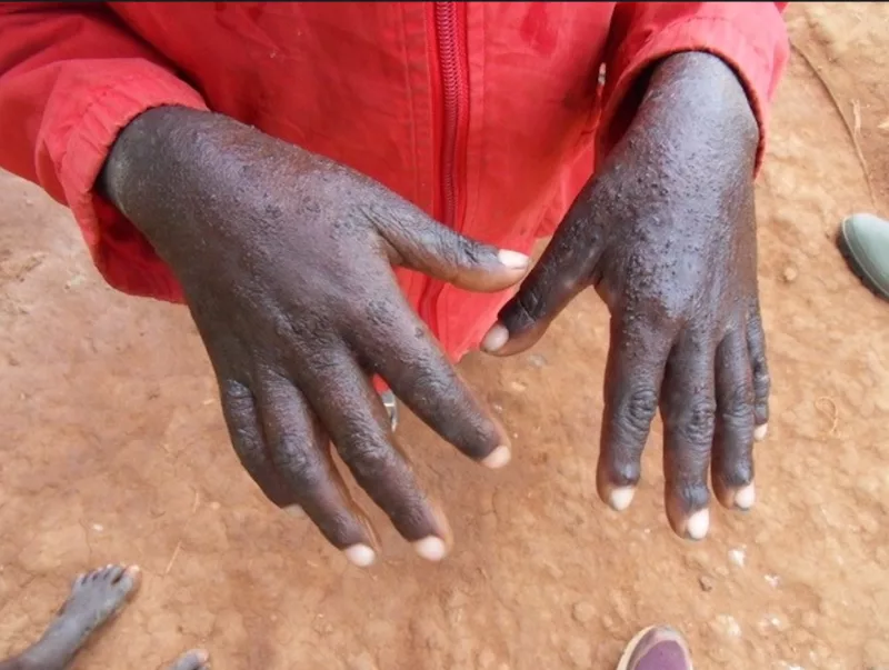 Study exposes hidden scabies crisis in overcrowded prisons