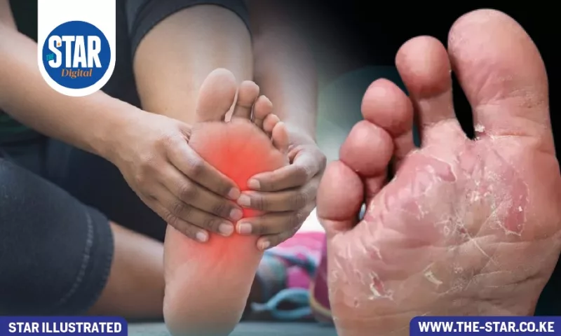 What to know about athlete's foot