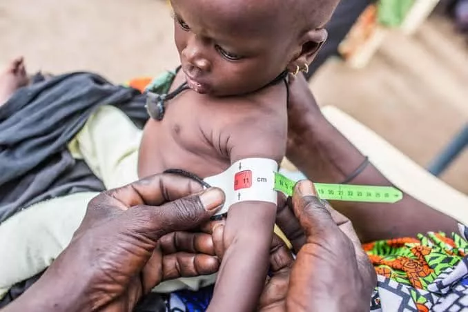 Study: Use plant-based therapeutic food for cheaper malnutrition treatment